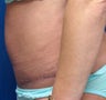 Tummy Tuck