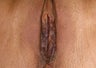 Labiaplasty