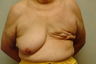 70-year-old Breast Reconstruction patient had bilateral reconstruction