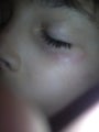 12 year old boy with facial veins below left eye