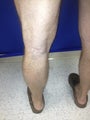 48 year old male with severe varicose veins