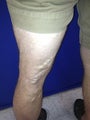 48 year old male with severe varicose veins