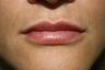 Lip Augmentation