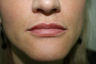 Lip Augmentation
