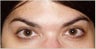 Botox
