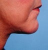 57 Year Old Female Treated For Weak Chin and Saggy Neck