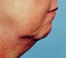 57 Year Old Female Treated For Weak Chin and Saggy Neck