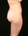 Body Contouring - Belt Lipectomy