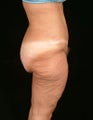 Body Contouring - Belt Lipectomy