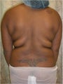 Laser Lipo