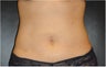 SmartLipo MPX