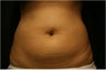 SmartLipo MPX