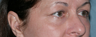 Fraxel Repair Around the Eyes
