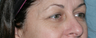 Fraxel Repair Around the Eyes
