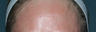Before & After Fraxel Laser