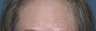 Before & After Fraxel Laser
