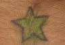 Star - Tattoo Removal
