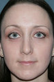 Fraxel Repair for Acne Treatment