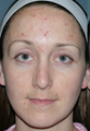 Fraxel Repair for Acne Treatment