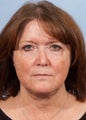 Female Chin/Neck Liposuction