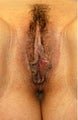 Labiaplasty with Labial Reduction