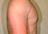 Liposuction for Gynecomastia