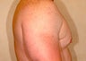 Liposuction for Gynecomastia