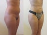 Brazilian Butt Lift