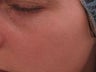 IPL Treatment for Pigmentation