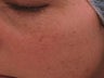 IPL Treatment for Pigmentation