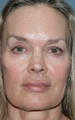 Fraxel Repair Laser Treatment