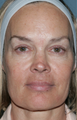 Fraxel Repair Laser Treatment