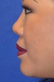 Nonsurgical Rhinoplasty Using Facial Filler