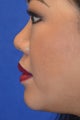 Nonsurgical Rhinoplasty Using Facial Filler