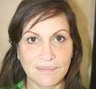 Mini Face Lift, Brow Lift and Upper Blepharoplasty