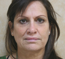 Mini Face Lift, Brow Lift and Upper Blepharoplasty