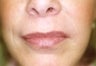 Female patient who underwent dermabrasion