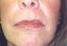 Female patient who underwent dermabrasion
