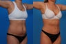 Tummy Tuck: 29-Year-Old Woman