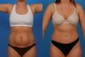 Tummy Tuck: 29-Year-Old Woman