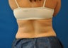CoolSculpting