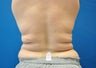 CoolSculpting