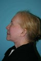 75 year old patient treated for facial rejuvenation