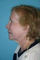 75 year old patient treated for facial rejuvenation