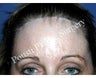 Forehead Lift