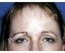 Forehead Lift