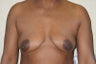 Breast Augmentation with peri-areolar lift