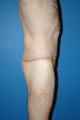 body lift in a male bariatric patient