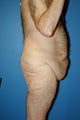 body lift in a male bariatric patient