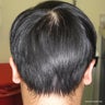"Stealth" technique of the robotic FUE hair transplantation